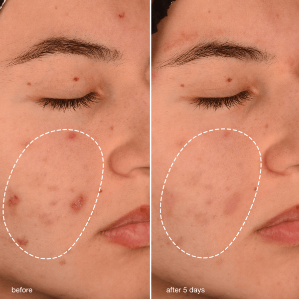 Breakout Biotic Moisturizer 50ml